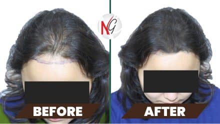 Before and after female hair transplant — hairline