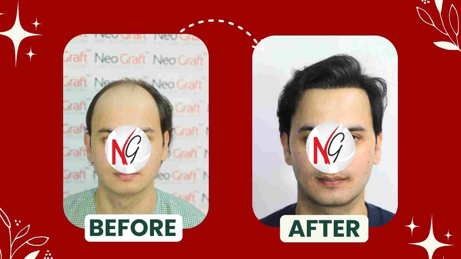 Front view before and after a NeoGraft hair transplant — receding hairline restored