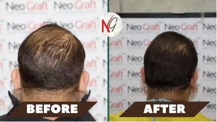 Before and after hair transplant at NeoGraft — male patient 1