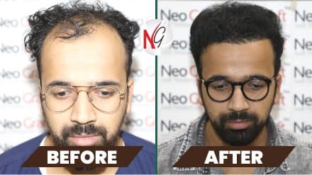 Before and after hair transplant at NeoGraft — male patient 10