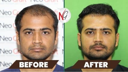 Before and after hair transplant at NeoGraft — male patient 11