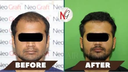 Before and after hair transplant at NeoGraft — male patient 2