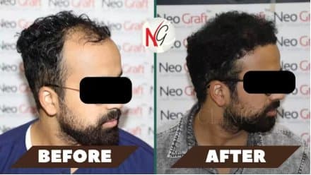 Before and after hair transplant at NeoGraft — male patient 3