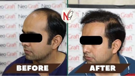 Before and after hair transplant at NeoGraft — male patient 4