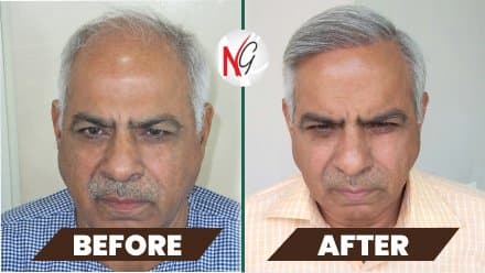Before and after hair transplant at NeoGraft — male patient 5