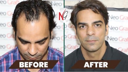 Before and after hair transplant at NeoGraft — male patient 6