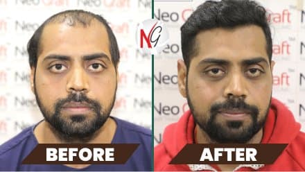 Before and after hair transplant at NeoGraft — male patient 7