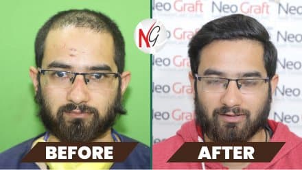Before and after hair transplant at NeoGraft — male patient 8