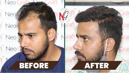 Before and after hair transplant at NeoGraft — male patient 9
